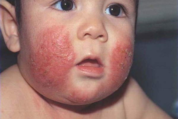 Chàm sữa là căn bệnh khởi đầu của chàm thể tạng.